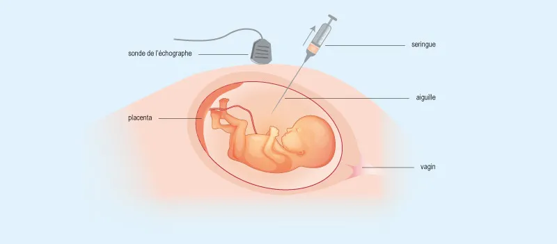 explication Amniocenthèse Sousse Tunisie