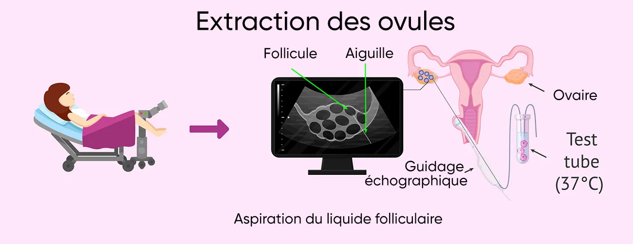 Extraction des ovules Sousse Tunisie