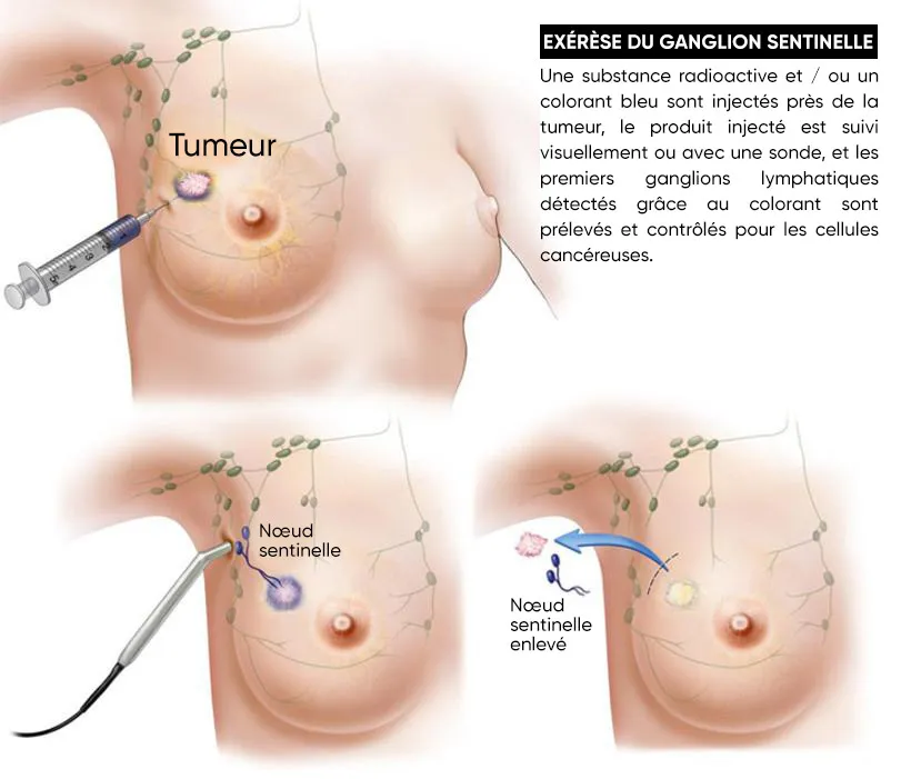 Exérèse du ganglion sentinelle | Clinique El Yosr maternité Sousse ...