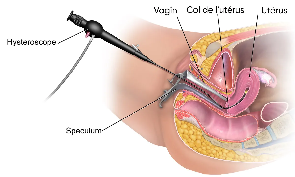 Hystéroscopie Sousse Tunisie