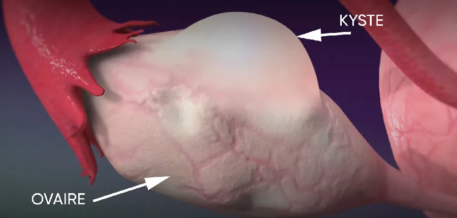Les kystes ovariens | Clinique El Yosr maternité Sousse Tunisie