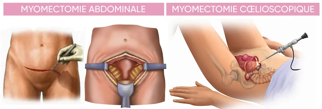 Myomectomie Sousse Tunisie